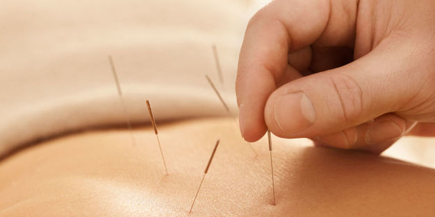 Prevention of Lower Back Pain accupuncture
